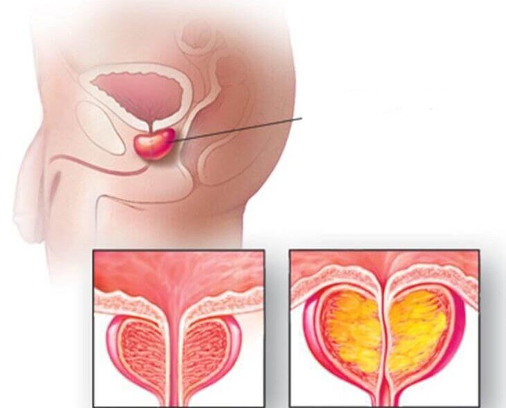 Eesnäärme asukoht, normaalne eesnääre ja suurenenud kroonilise prostatiidi korral