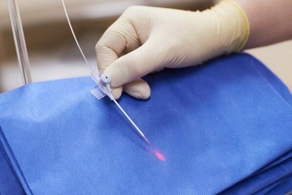 Mõnel juhul kasutatakse kroonilise prostatiidi korral laserteraapiat