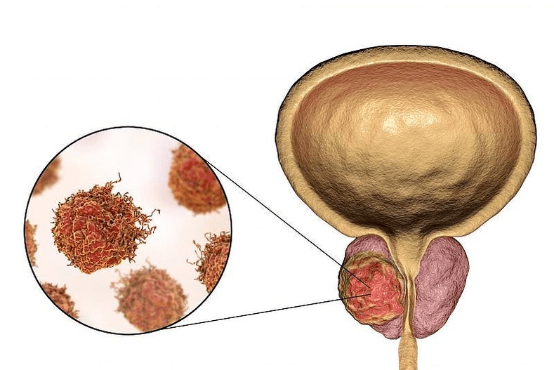 kuidas eesnäärme kahjustus välja näeb