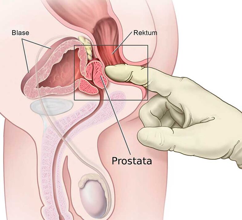 eesnäärme massaaž prostatiidi korral